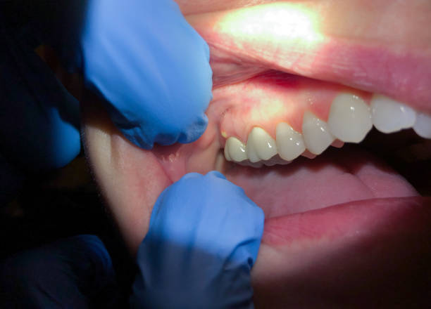 Best Emergency Tooth Extraction in Sandy Springs, SC